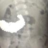 Hepsi iki yaşında çocuğun midesinden çıktı Hepsi iki yaşında çocuğun midesinden çıktı