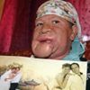 Çenesinde çıkan sivilceyi önemsemedi! Hayatı karardı Çenesinde çıkan sivilceyi önemsemedi! Hayatı karardı