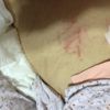 Denizli'de yatalak ALS hastasının karnına tırnakla ‘ATT' yazıldı iddiası Denizli'de yatalak ALS hastasının karnına tırnakla ‘ATT' yazıldı iddiası