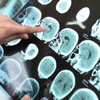 Alzheimer, artık daha erken teşhis edilebilecek Alzheimer, artık daha erken teşhis edilebilecek