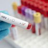Hepatit sahibi her 10 kişiden 9'u hastalığından habersiz