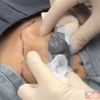 Sırtındaki şişliğin içinden çıkanlar doktoru şoke etti! Kan donduran görüntü... Sırtındaki şişliğin içinden çıkanlar doktoru şoke etti! Kan donduran görüntü...