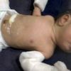 Hindistan’da bir bebek 'hamile' doğdu