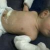 Hindistan'da bir bebek hamile doğdu