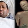 8 kiloluk tümöründen Türkiye'de kurtuldu