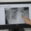 Koronavirüsün akciğerdeki ağır tahribatı, hastaların tomografi görüntülerine yansıdı Koronavirüsün akciğerdeki ağır tahribatı, hastaların tomografi görüntülerine yansıdı