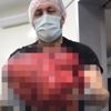 Karın şişliğiyle gittiği hastanede karnından 14 kilogram kitle çıktı Karın şişliğiyle gittiği hastanede karnından 14 kilogram kitle çıktı