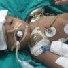 Hindistan'da yapışık ikizler ameliyatla ayrıldı