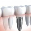 22 ülkeye implant satıyor