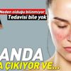 Lupus hastalığı (SLE hastalığı) nedir? Lupus hastalığı ölümcül müdür?