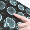 Parkinson hastalığına "beyin pili" tedavisi Parkinson hastalığına "beyin pili" tedavisi