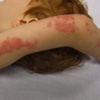 Lupus, tedavi edilmezse ölümcül olabilir Lupus, tedavi edilmezse ölümcül olabilir