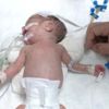 900 gramlık Umut bebeğe kalp ameliyatı 900 gramlık Umut bebeğe kalp ameliyatı