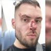 Alman polisi Türk gencin burnunu kırdı Alman polisi Türk gencin burnunu kırdı