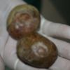 Mesanesinden yumurta büyüklüğünde taşlar çıktı Mesanesinden yumurta büyüklüğünde taşlar çıktı