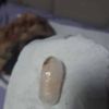 Tam 198 gram! Hepsi midesinden çıktı