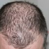 Dermatoloji uzmanı açıkladı: Covid-19 geçirenlerde 'saç dökülmesi' tehlikesi Dermatoloji uzmanı açıkladı: Covid-19 geçirenlerde 'saç dökülmesi' tehlikesi