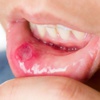 Ağız içi yaralarının sebebi