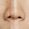 Ciltte pigment bozukluğu nedir? Pigment bozukluğunun nedenleri, çeşitleri ve tedavisi… Ciltte pigment bozukluğu nedir? Pigment bozukluğunun nedenleri, çeşitleri ve tedavisi…