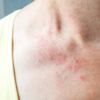 Nörofibromatozis hastalığı nedir? Nörofibromatozis hastalığının nedenleri, belirtileri ve tedavisi… Nörofibromatozis hastalığı nedir? Nörofibromatozis hastalığının nedenleri, belirtileri ve tedavisi…