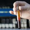İngiltere'de 50'den fazla kanser türünü erken tespit etmesi umulan kan testi denenecek İngiltere'de 50'den fazla kanser türünü erken tespit etmesi umulan kan testi denenecek