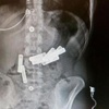 Midesinden çıkanlara doktorlar bile inanamadı Midesinden çıkanlara doktorlar bile inanamadı