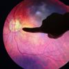 Diabetik Retinopati Nedir? Diabetik Retinopati Nedir?