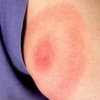 Yüzyılın gizli salgını: LYME hastalığı Yüzyılın gizli salgını: LYME hastalığı