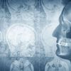 Alzheimer hastalığı aslında Tip-3 diyabet mi? Alzheimer hastalığı aslında Tip-3 diyabet mi?