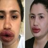 Silikon mağduru hemşireden haber var Silikon mağduru hemşireden haber var