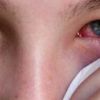 Yeni salgın Adenovirüs nedir? Adenovirüs nasıl bulaşır? Adenovirüs belirtileri neler? Korona kadar yayılabiliyor