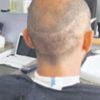 Yanlış saç ekimine tazminat davası Yanlış saç ekimine tazminat davası