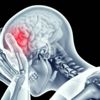 Epilepsi nöbetini 1 saat önceden tahmin eden yapay zeka Epilepsi nöbetini 1 saat önceden tahmin eden yapay zeka