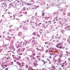 Hepatitten her yıl 1 milyon kişiyi ölüyor Hepatitten her yıl 1 milyon kişiyi ölüyor