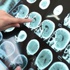 Alzheimer, artık daha erken teşhis edilebilecek Alzheimer, artık daha erken teşhis edilebilecek