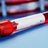 Hct (hematokrit) testi hakkında merak edilenler Hct (hematokrit) testi hakkında merak edilenler