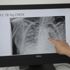 Koronavirüsün akciğerdeki ağır tahribatı, hastaların tomografi görüntülerine yansıdı Koronavirüsün akciğerdeki ağır tahribatı, hastaların tomografi görüntülerine yansıdı