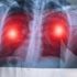 Pulmoner alveoler mikrolitiazis nedir? Pulmoner alveoler mikrolitiazis nedenleri, belirtileri ve tedavisi… Pulmoner alveoler mikrolitiazis nedir? Pulmoner alveoler mikrolitiazis nedenleri, belirtileri ve tedavisi…