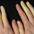 El ve ayakların çok üşümesine dikkat! (Raynaud sendromu nedir, raynaud fenomeni nasıl tedavi edilir) El ve ayakların çok üşümesine dikkat! (Raynaud sendromu nedir, raynaud fenomeni nasıl tedavi edilir)
