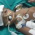 Hindistan'da yapışık ikizler ameliyatla ayrıldı