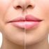 Uçuk (Herpes Simpleks Virus) nedir? Uçuk bulaşıcı mıdır? Uçuk nasıl geçer? Uçuk (Herpes Simpleks Virus) nedir? Uçuk bulaşıcı mıdır? Uçuk nasıl geçer?