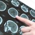 Parkinson hastalığına "beyin pili" tedavisi