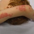 Lupus, tedavi edilmezse ölümcül olabilir