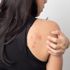 Atopik dermatit (Egzama) nedir? Atopik dermatit nedenleri, belirtileri ve tedavisi…