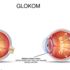 Göz tansiyonu nedir? Göz tansiyonu belirtileri nelerdir? Göz tansiyonu nedir? Göz tansiyonu belirtileri nelerdir?