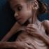 Yemen'deki iç savaşın sembolü olan 'Emel' yaşamını yitirdi