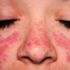 Kelebek hastalığı (lupus) neden olur, belirtileri nelerdir, nasıl tedavi edilir?