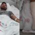 Motosikletin pedalı bacağına saplandı! Motosikletin pedalı bacağına saplandı!