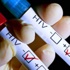 Türkiye’de HIV tehlikesi artıyor Türkiye’de HIV tehlikesi artıyor