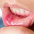 Ağız içi yaralarının sebebi